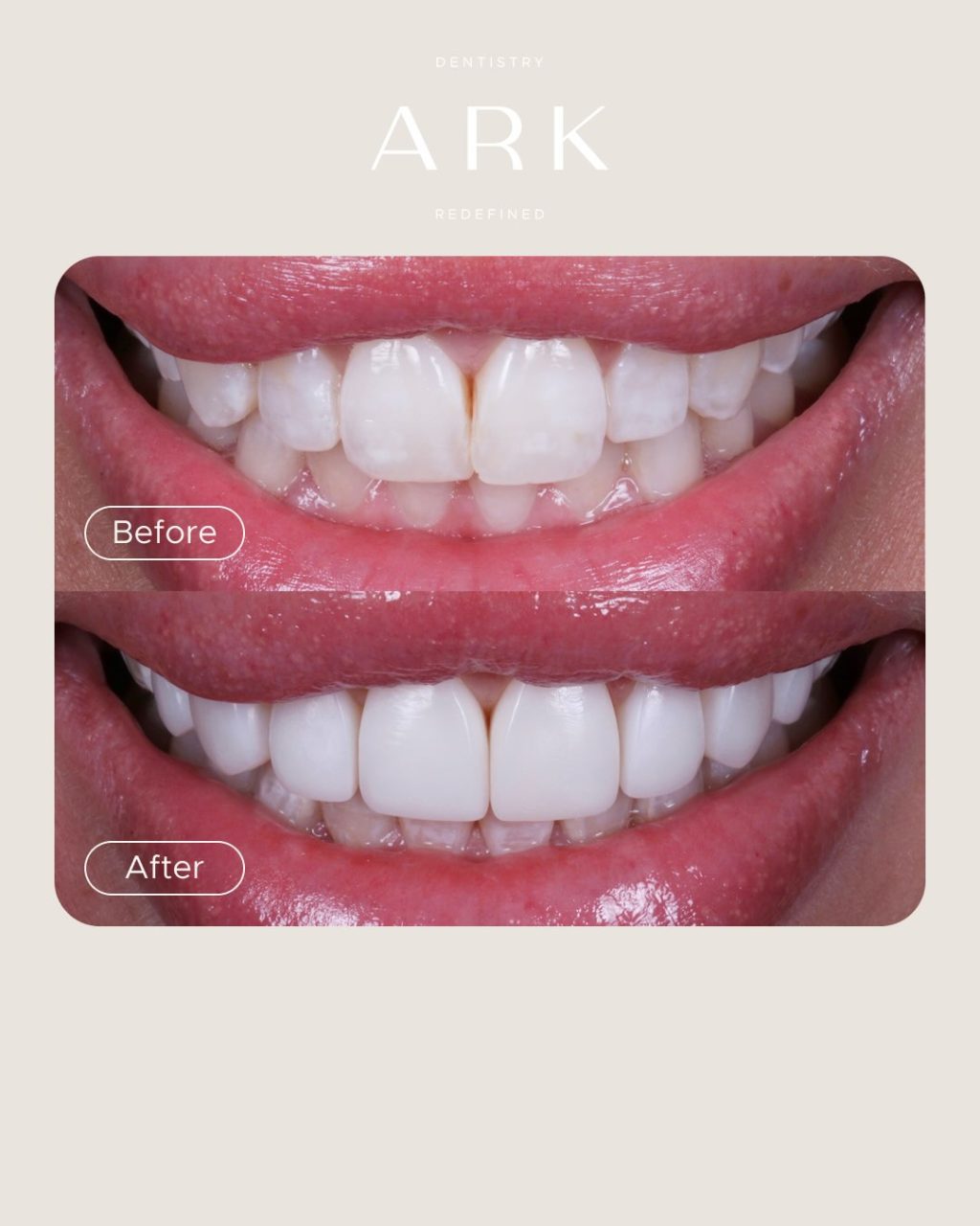 The details make the difference ✨

These Composite Bonding transformations were carefully designed to enhance the natural shape and proportions of each smile, creating results that feel seamless, balanced and completely bespoke 🤝

Your smile. Redefined by Ark Dentistry 🦷

#ArkDentistry #CompositeBonding #BeforeAndAfter #SmileTransformation