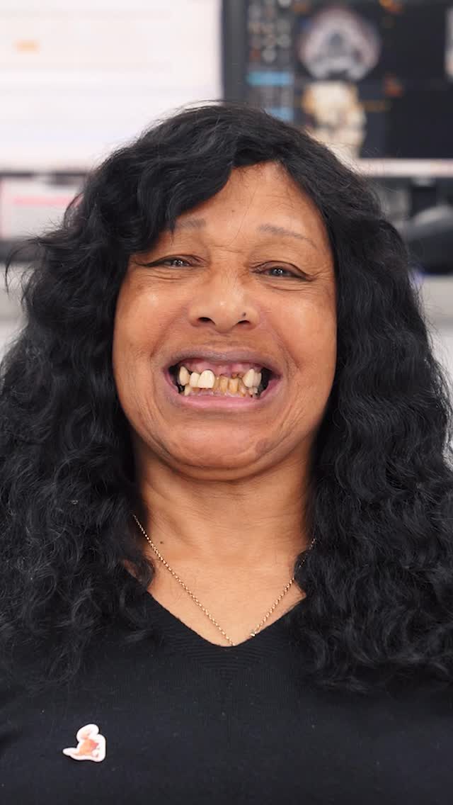 After struggling with her teeth for several years, Geraldine made the decision to visit Ark to transform her smile ✨

She had several missing teeth and was unhappy with both the appearance of her smile and her ability to eat comfortably. 

Her goal was to improve her bite, function, and overall appearance, restoring her confidence to smile again 🥹

This transformation was completed in just one appointment, achieving instant results. 

Ready to start your own smile journey? Send us a message and we’ll guide you through your options 🤍

#ArkDentistry #DentalImplants #TeethInADay #SmileTransformation