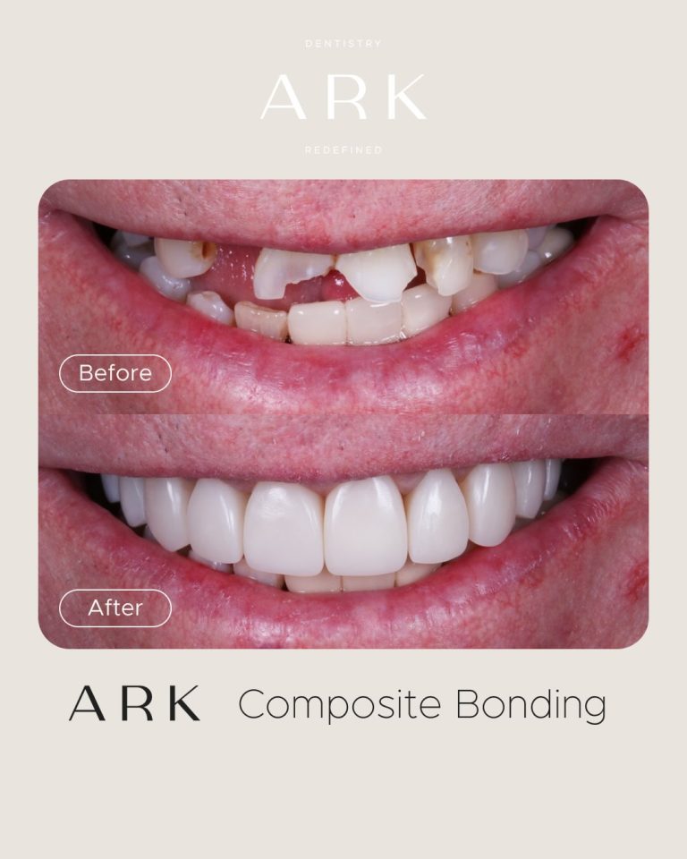 The details make the difference ✨

These Composite Bonding transformations were carefully designed to enhance the natural shape and proportions of each smile, creating results that feel seamless, balanced and completely bespoke 🤝

Your smile. Redefined by Ark Dentistry 🦷

#ArkDentistry #CompositeBonding #BeforeAndAfter #SmileTransformation