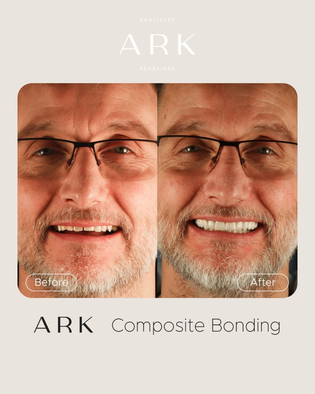 What a transformation! 👏✨

From discoloured and uneven, to bright, symmetrical and naturally balanced results, completed in a single visit. 

Thinking about transforming your smile with Composite Bonding? Get in touch today 🤍

#ArkDentistry #CompositeBonding #SmileTransformation