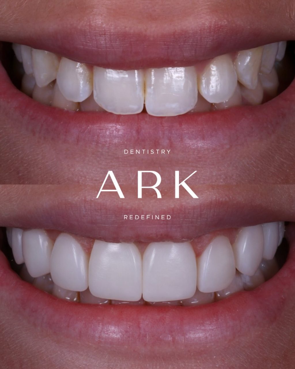 Thinking about composite bonding but unsure how it will look? 🦷

Our approach is completely bespoke, tailored to your features, preferences, and smile goals.

Bring your inspiration to your consultation, and together we’ll design a smile that feels like you! 😁