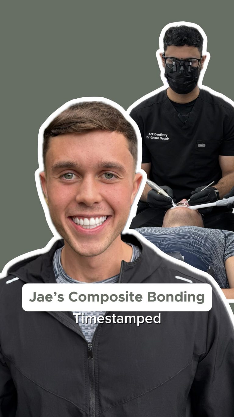 Composite Bonding time check for @jkitchen.cooks ⏰✨

Jae’s 18-tooth smile transformation, completed with Composite Bonding in just one appointment 🦷

18 teeth. One appointment. One brand-new smile 🤝

#ArkDentistry #CosmeticDentistry #SmileTransformation