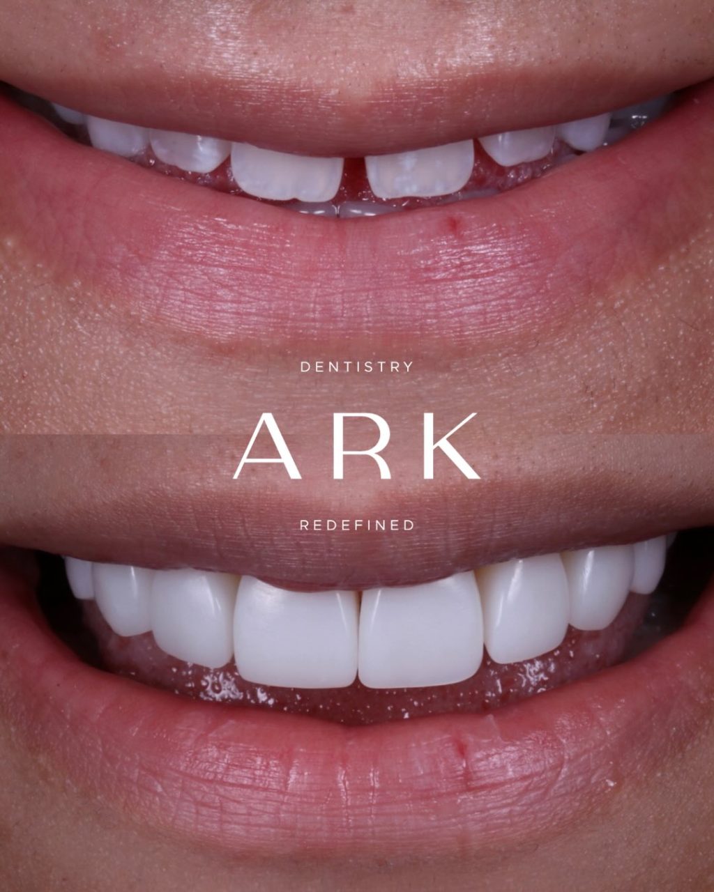 Whether you’re after subtle refinements or a more noticeable transformation, composite bonding is all about creating a smile that still feels like you. 

Each treatment is carefully tailored to the individual, focusing on balance, proportion, and results that look natural, feel comfortable and complement your unique features. 🦷✨

Ready for yours? Book in for your free consultation today!

#ArkDentistry #CompositeBonding #BeforeAndAfter #SmileTransformation