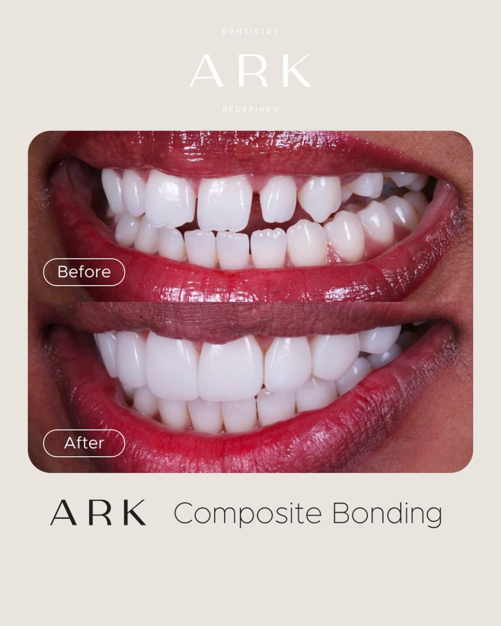 Gaps, stains or chips in your smile? 👀

Composite Bonding could be the smile transformation you’ve been looking for ✨

Using carefully sculpted composite, we can enhance the shape, colour and symmetry of your smile - creating a natural-looking result designed to you. 

Ready to transform your smile? 🦷 Drop us a DM to start your journey! 

#ArkDentistry #CompositeBonding #SmileTransformation