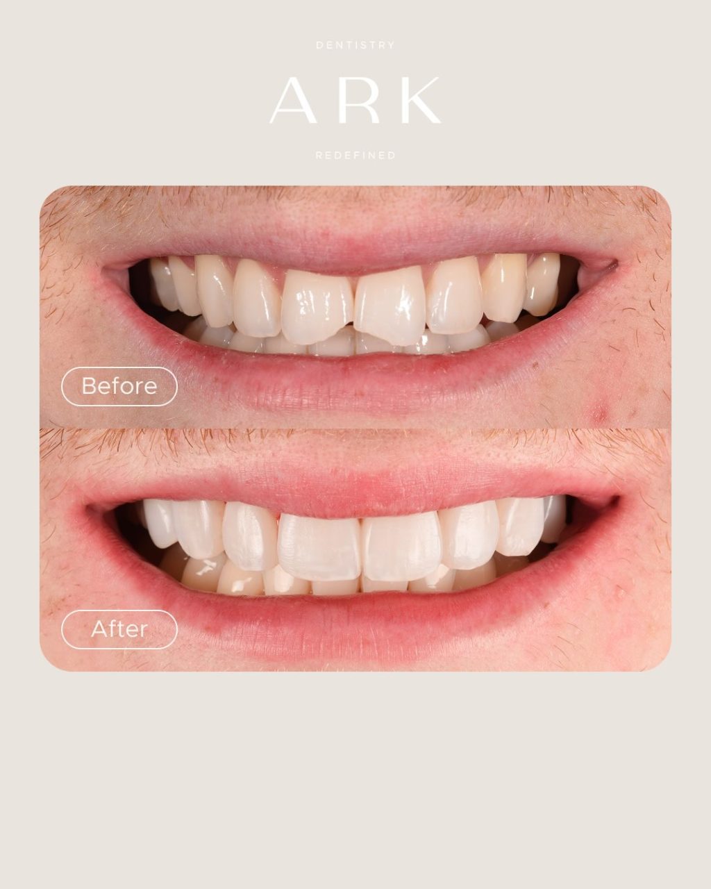 The details make the difference ✨

These Composite Bonding transformations were carefully designed to enhance the natural shape and proportions of each smile, creating results that feel seamless, balanced and completely bespoke 🤝

Your smile. Redefined by Ark Dentistry 🦷

#ArkDentistry #CompositeBonding #BeforeAndAfter #SmileTransformation