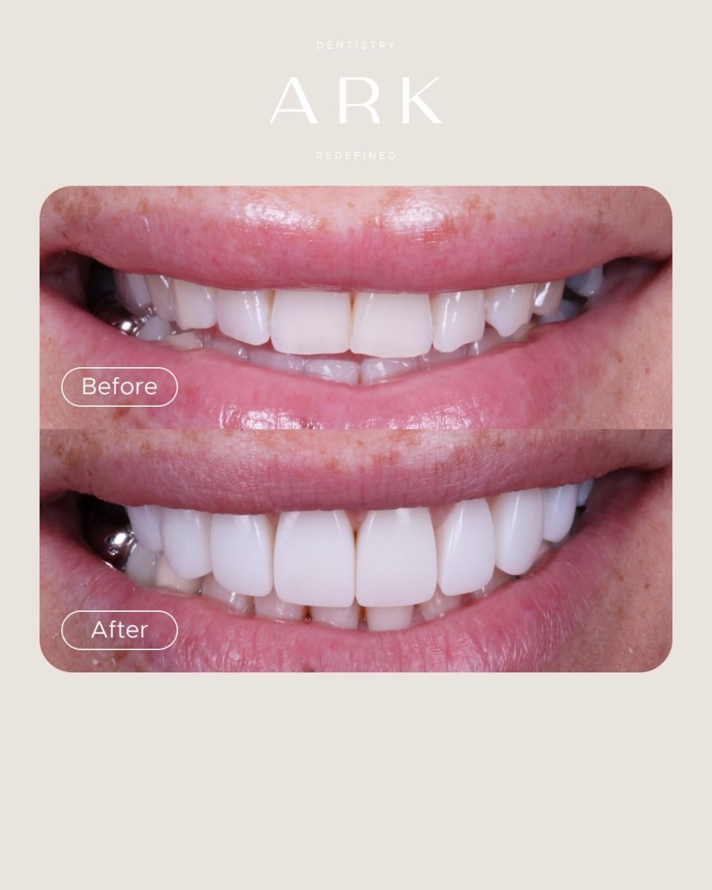It’s all in the detail ✨

Every Composite Bonding transformation we create is tailored to the individual, taking into account tooth shape, proportions, symmetry and overall facial harmony.

The goal is never to make every smile look the same, but to create a result that feels natural, balanced and uniquely yours 🤝

Thoughtful planning. Precise artistry. Beautifully refined results 🦷

#ArkDentistry #CompositeBonding #SmileTransformation