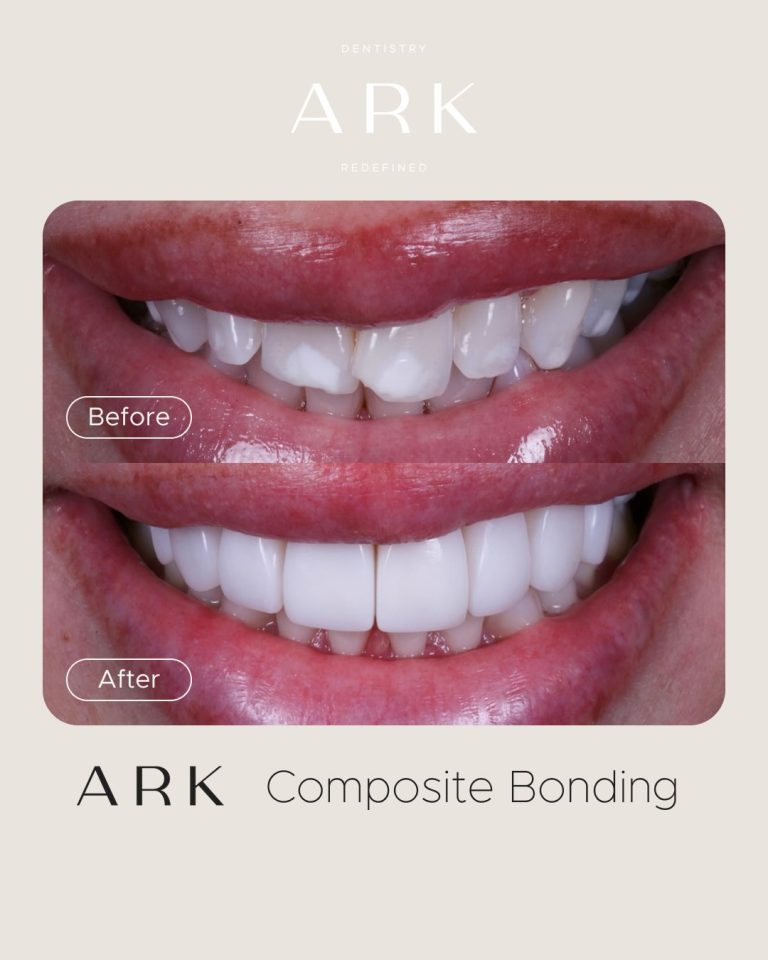Small changes. Big transformations ✨

A beautifully refined smile starts with an understanding of shape, symmetry, proportions and the way each tooth complements the next. 

These Composite Bonding transformations were tailored to each individual smile, creating results that feel natural and uniquely yours 🤝

Ready to transform your smile? 🦷

#ArkDentistry #CompositeBonding #SmileTransformation